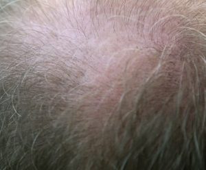 Hier zu sehen ist eine Frau mit kreisrundem Haarausfall | Haarausfall Frauen - Hair&Style Altbach